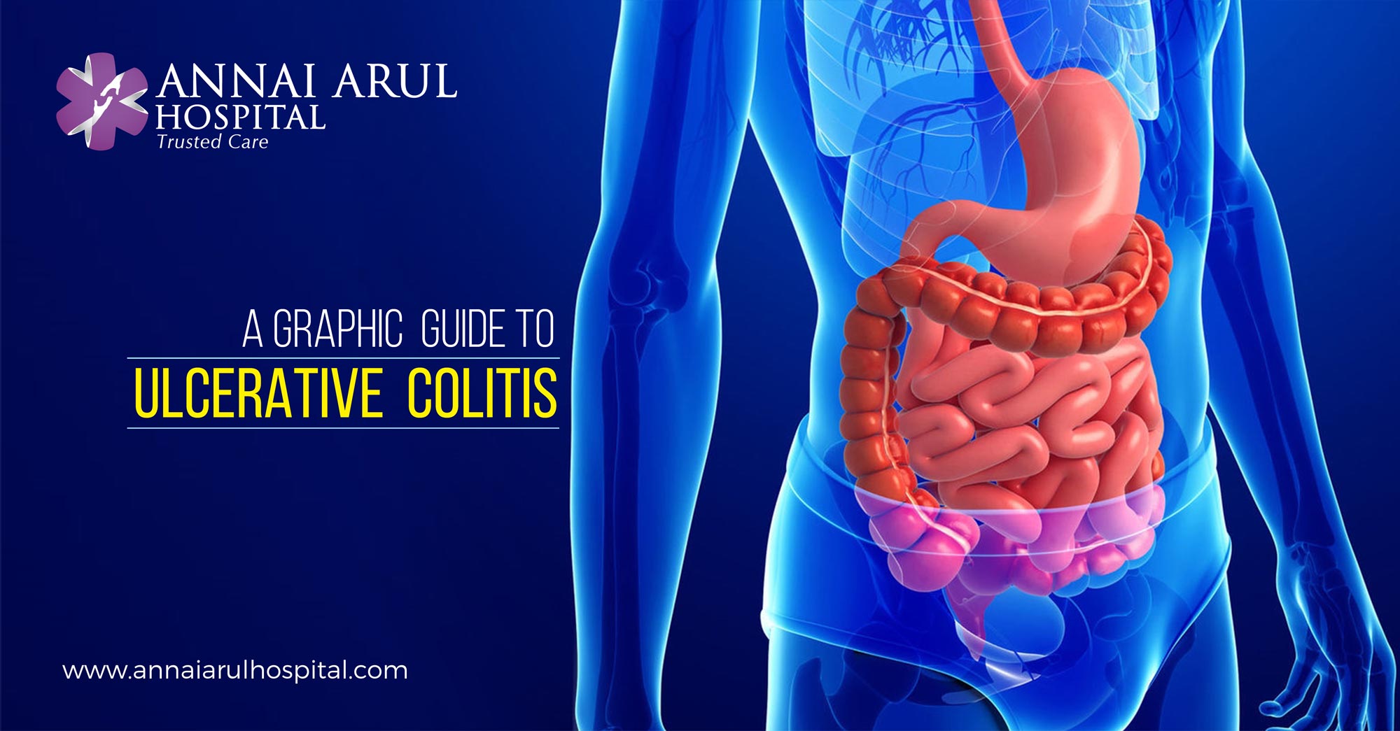 A GRAPHIC GUIDE TO ULCERATIVE COLITIS Multispeciality Hospitals in